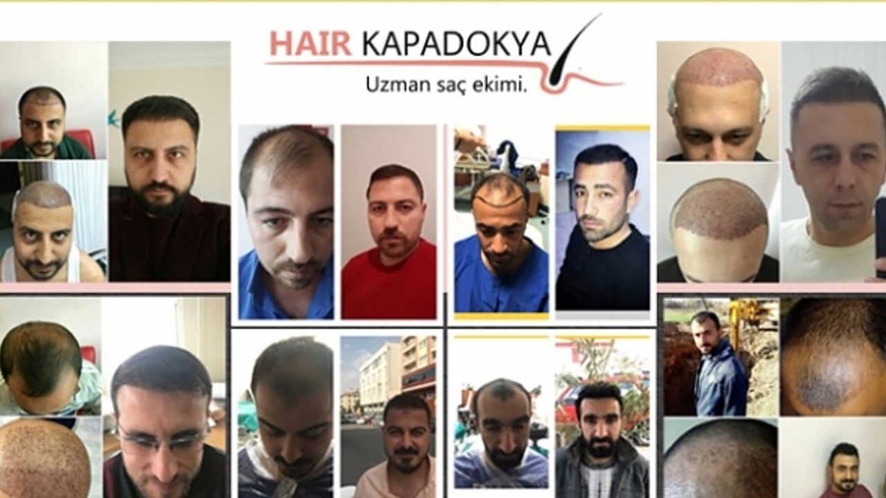 Ömür Boyu Garantili Saç Ekimi Artık Nevşehir’de