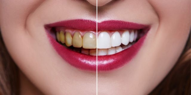 Dişleri Beyazlatmanın Yolları