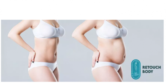 Liposuction ve Karın Germe Estetik Yöntemleri